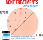 Topical Probiotic Skin Cream - 4OZ Jar 13 Strain Moisturizing Probiotic Lotion Eczema Treatment Psoriasis Treatment for Cystic Acne Probiotic Skin Care Cream Nail Fungus Treatment